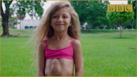 The girl born with heart outside her chest – Incredible Medicine: Dr Weston's Casebook Preview – BBC